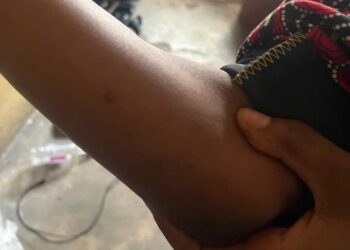 Students of R/S College of Health Sci & Tech Raise Alarm Over Presence of Bedbugs in Mattresses