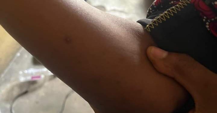 Students of R/S College of Health Sci & Tech Raise Alarm Over Presence of Bedbugs in Mattresses