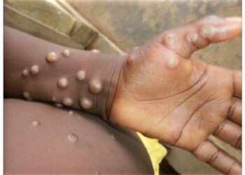 Sweden Records First Case of Mpox as WHO Declares it as Public Health Emergency
