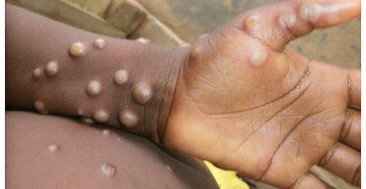 Sweden Records First Case of Mpox as WHO Declares it as Public Health Emergency